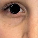 Platelet Rich Plasma (PRP) Before & After Patient #1040