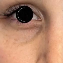 Platelet Rich Plasma (PRP) Before & After Patient #1040