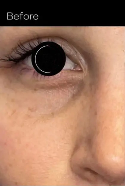 Platelet Rich Plasma (PRP) Before & After Patient #1040