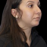 Primary Rhinoplasty Before & After Patient #1175