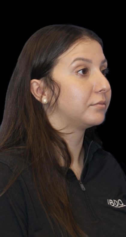 Primary Rhinoplasty Before & After Patient #1175