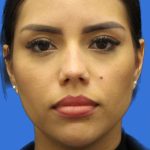 Primary Rhinoplasty Before & After Patient #1186