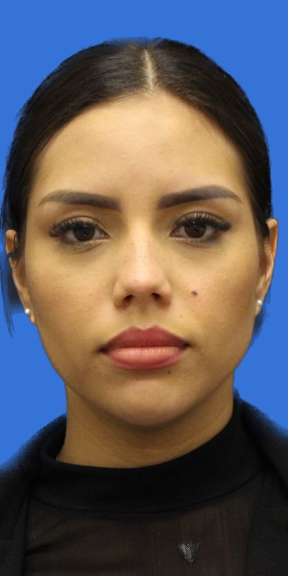 Primary Rhinoplasty Before & After Patient #1186