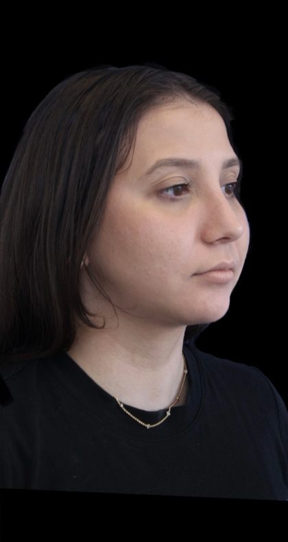 Primary Rhinoplasty Before & After Patient #1175