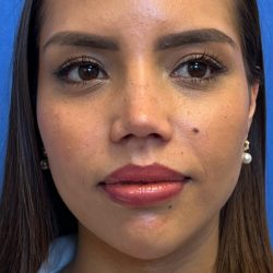 Primary Rhinoplasty Before & After Patient #1186
