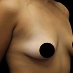 Breast Lift Before & After Patient #1183