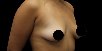 Breast Lift Before & After Patient #1183