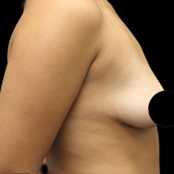 Breast Lift Before & After Patient #1183