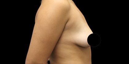 Breast Lift Before & After Patient #1183