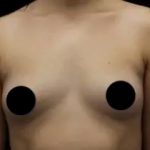 Breast Augmentation Before & After Patient #1184
