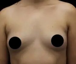 Breast Augmentation Before & After Patient #1184