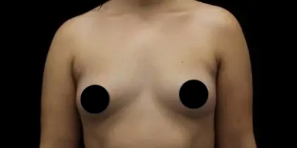 Breast Augmentation Before & After Patient #1184