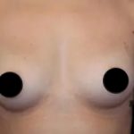 Breast Augmentation Before & After Patient #1185