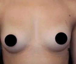 Breast Augmentation Before & After Patient #1185