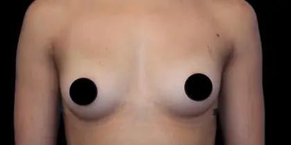 Breast Augmentation Before & After Patient #1185