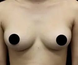 Breast Augmentation Before & After Patient #1187