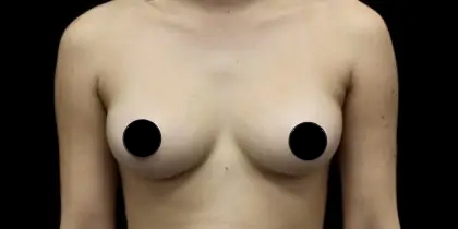 Breast Augmentation Before & After Patient #1187