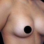 Breast Lift Before & After Patient #1183