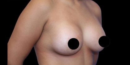 Breast Lift Before & After Patient #1183