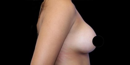 Breast Lift Before & After Patient #1183