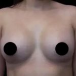 Breast Augmentation Before & After Patient #1184