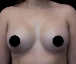 Breast Augmentation Before & After Patient #1184