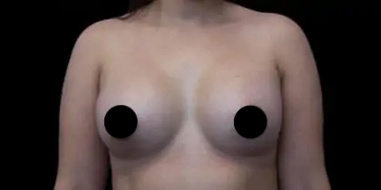 Breast Augmentation Before & After Patient #1184