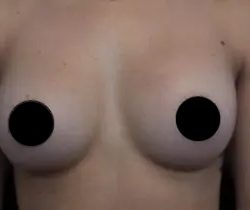Breast Augmentation Before & After Patient #1185