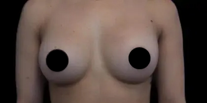 Breast Augmentation Before & After Patient #1185