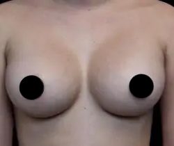 Breast Augmentation Before & After Patient #1187