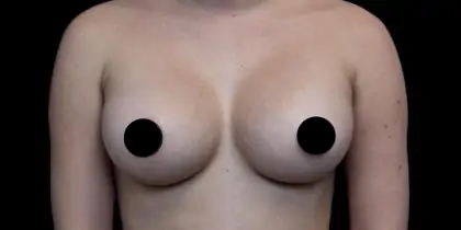 Breast Augmentation Before & After Patient #1187