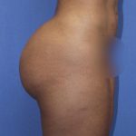 BBL Reduction Before & After Patient #1173