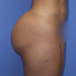 BBL Reduction Before & After Patient #1173