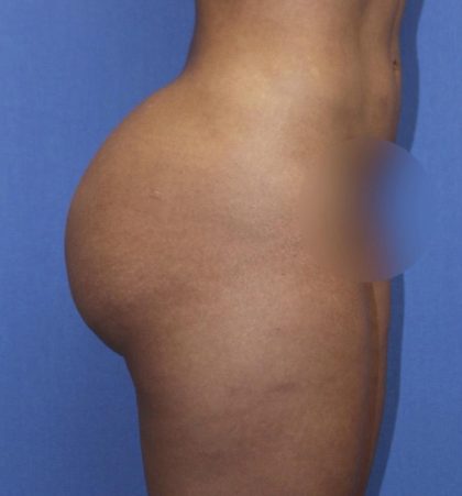BBL Reduction Before & After Patient #1173