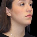 Primary Rhinoplasty Before & After Patient #1182