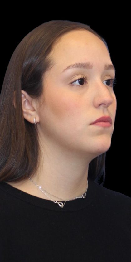 Primary Rhinoplasty Before & After Patient #1182