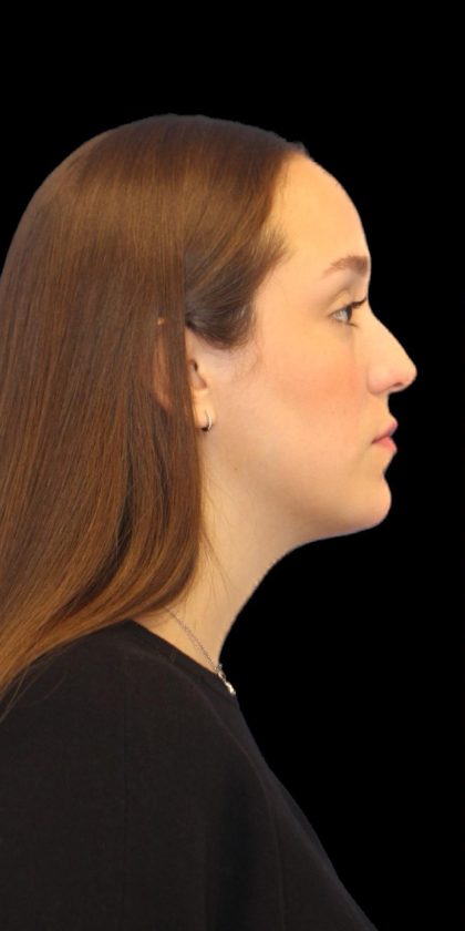 Primary Rhinoplasty Before & After Patient #1182