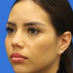 Primary Rhinoplasty Before & After Patient #1186