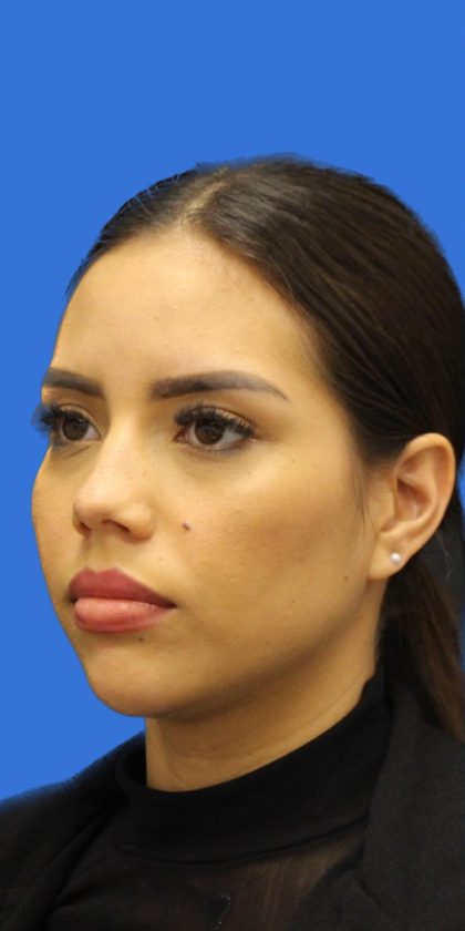 Primary Rhinoplasty Before & After Patient #1186