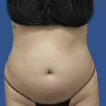 Brazilian Butt Lift Before & After Patient #1174