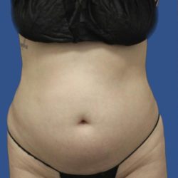 Brazilian Butt Lift Before & After Patient #1174