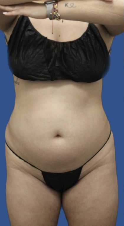 Brazilian Butt Lift Before & After Patient #1174
