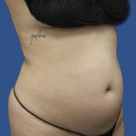 Brazilian Butt Lift Before & After Patient #1174