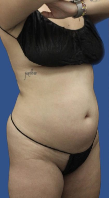 Brazilian Butt Lift Before & After Patient #1174