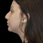 Primary Rhinoplasty Before & After Patient #1175