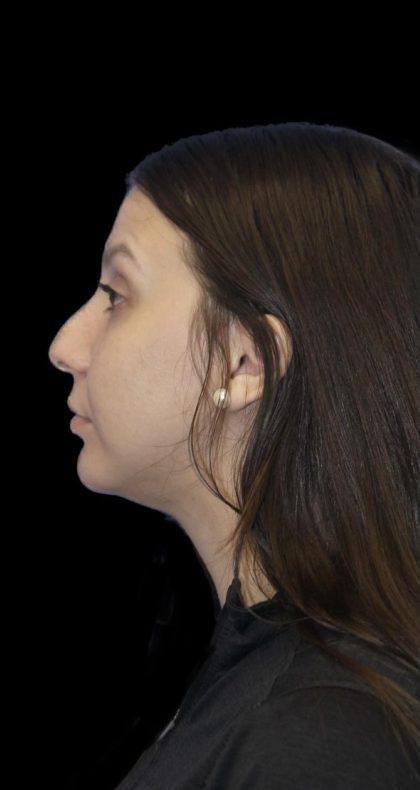 Primary Rhinoplasty Before & After Patient #1175