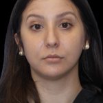 Primary Rhinoplasty Before & After Patient #1175
