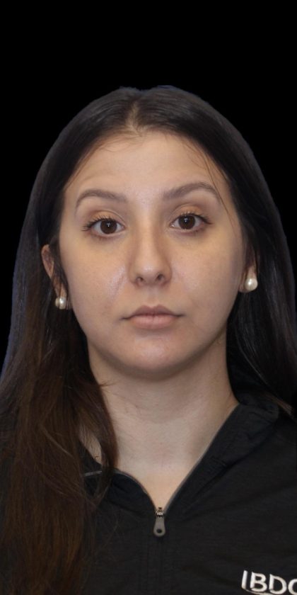 Primary Rhinoplasty Before & After Patient #1175