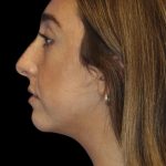 Primary Rhinoplasty Before & After Patient #1176