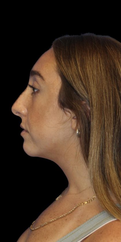 Primary Rhinoplasty Before & After Patient #1176
